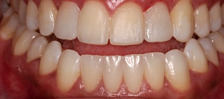 Before and After Invisalign Treatment Milton Keynes Before and After Invisalign Treatment Milton Keynes