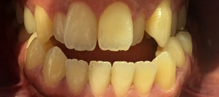Before and After Invisalign Treatment Milton Keynes Before and After Invisalign Treatment Milton Keynes