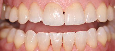 Before and After Invisalign Treatment Milton Keynes Before and After Invisalign Treatment Milton Keynes