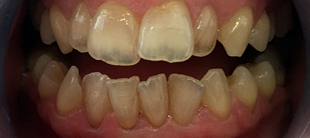 Before and After Invisalign Treatment Milton Keynes Before and After Invisalign Treatment Milton Keynes