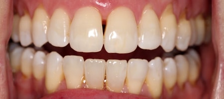 Before and After Invisalign Treatment Milton Keynes Before and After Invisalign Treatment Milton Keynes