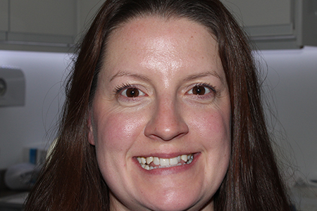 Before and After Invisalign Treatment Milton Keynes Before and After Invisalign Treatment Milton Keynes