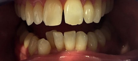 Before and After Invisalign Treatment Milton Keynes Before and After Invisalign Treatment Milton Keynes