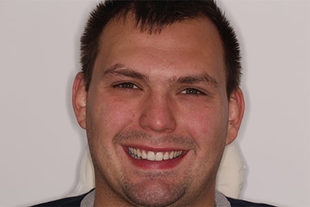 Before and After Invisalign Treatment Milton Keynes Before and After Invisalign Treatment Milton Keynes