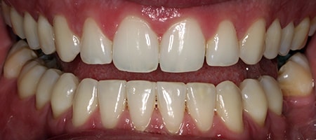 Before and After Invisalign Treatment Milton Keynes Before and After Invisalign Treatment Milton Keynes