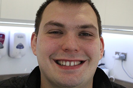 Before and After Invisalign Treatment Milton Keynes Before and After Invisalign Treatment Milton Keynes