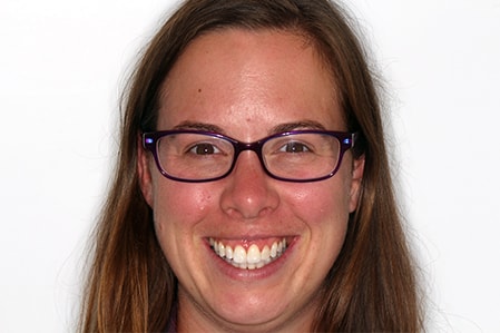 Before and After Invisalign Treatment Milton Keynes Before and After Invisalign Treatment Milton Keynes