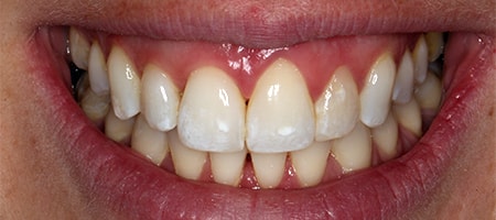 Before and After Invisalign Treatment Milton Keynes Before and After Invisalign Treatment Milton Keynes