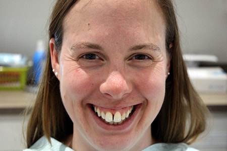 Before and After Invisalign Treatment Milton Keynes Before and After Invisalign Treatment Milton Keynes