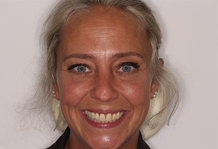 Before and After Invisalign Treatment Milton Keynes Before and After Invisalign Treatment Milton Keynes
