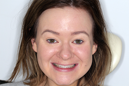 Before and After Invisalign Treatment Milton Keynes Before and After Invisalign Treatment Milton Keynes