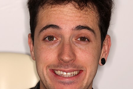 Before and After Invisalign Treatment Milton Keynes