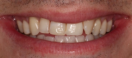 Before and After Invisalign Treatment Milton Keynes