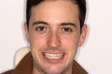 Before and After Invisalign Treatment Milton Keynes