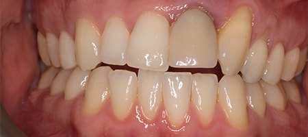 Before and After Invisalign Treatment Milton Keynes