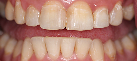 Before and After Invisalign Treatment Milton Keynes Before and After Invisalign Treatment Milton Keynes