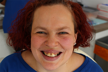 Before and After Invisalign Treatment Milton Keynes Before and After Invisalign Treatment Milton Keynes