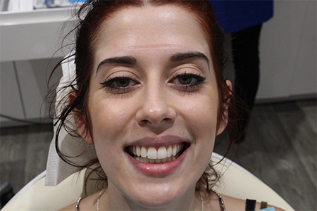 Before and After Invisalign Treatment Milton Keynes