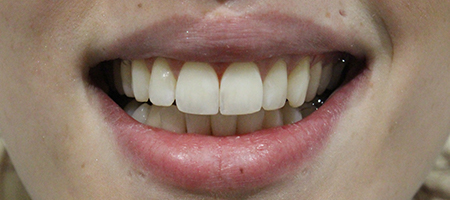 Before and After Invisalign Treatment Milton Keynes