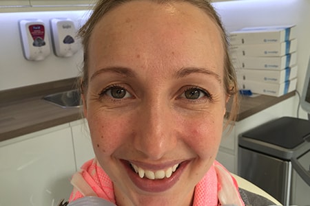 Before and After Invisalign Treatment Milton Keynes Before and After Invisalign Treatment Milton Keynes