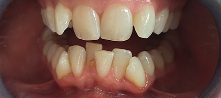 Before and After Invisalign Treatment Milton Keynes Before and After Invisalign Treatment Milton Keynes