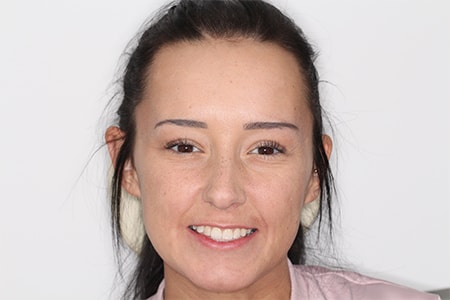 Before and After Invisalign Treatment Milton Keynes Before and After Invisalign Treatment Milton Keynes