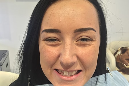 Before and After Invisalign Treatment Milton Keynes Before and After Invisalign Treatment Milton Keynes