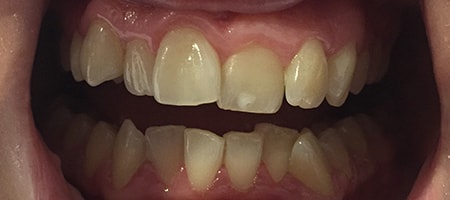 Before and After Invisalign Treatment Milton Keynes Before and After Invisalign Treatment Milton Keynes