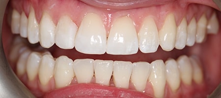 Before and After Invisalign Treatment Milton Keynes Before and After Invisalign Treatment Milton Keynes