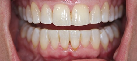 Before and After Invisalign Treatment Milton Keynes Before and After Invisalign Treatment Milton Keynes