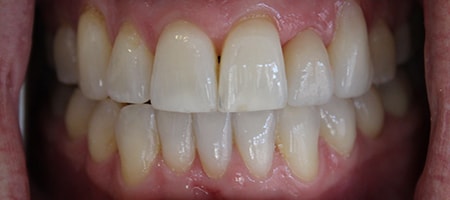 Before and After Invisalign Treatment Milton Keynes Before and After Invisalign Treatment Milton Keynes
