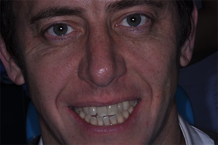 Before and After Invisalign Treatment Milton Keynes Before and After Invisalign Treatment Milton Keynes