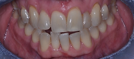 Before and After Invisalign Treatment Milton Keynes Before and After Invisalign Treatment Milton Keynes