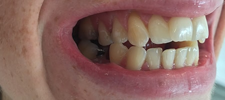 Before and After Invisalign Treatment Milton Keynes Before and After Invisalign Treatment Milton Keynes