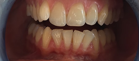 Before and After Invisalign Treatment Milton Keynes Before and After Invisalign Treatment Milton Keynes