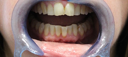 Before and After Invisalign Treatment Milton Keynes Before and After Invisalign Treatment Milton Keynes