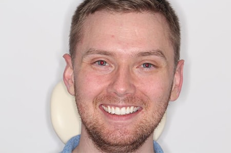 Before and After Invisalign Treatment Milton Keynes Before and After Invisalign Treatment Milton Keynes