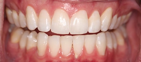 Before and After Invisalign Treatment Milton Keynes Before and After Invisalign Treatment Milton Keynes