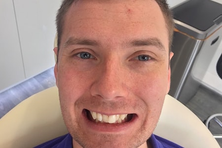Before and After Invisalign Treatment Milton Keynes Before and After Invisalign Treatment Milton Keynes