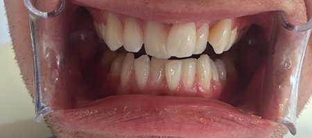 Before and After Invisalign Treatment Milton Keynes Before and After Invisalign Treatment Milton Keynes