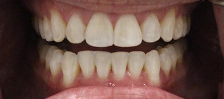 Before and After Invisalign Treatment Milton Keynes Before and After Invisalign Treatment Milton Keynes