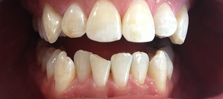 Before and After Invisalign Treatment Milton Keynes Before and After Invisalign Treatment Milton Keynes