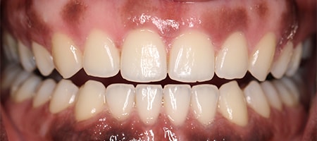 Before and After Invisalign Treatment Milton Keynes Before and After Invisalign Treatment Milton Keynes