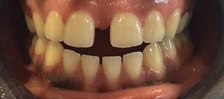 Before and After Invisalign Treatment Milton Keynes Before and After Invisalign Treatment Milton Keynes