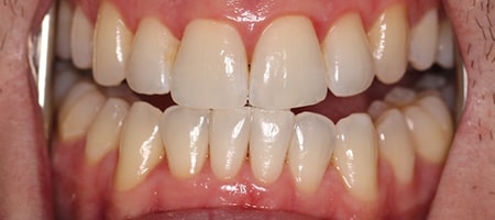 Before and After Invisalign Treatment Milton Keynes Before and After Invisalign Treatment Milton Keynes