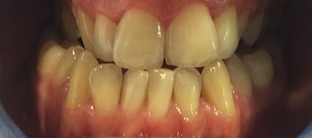 Before and After Invisalign Treatment Milton Keynes Before and After Invisalign Treatment Milton Keynes