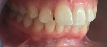 Before and After Invisalign Treatment Milton Keynes Before and After Invisalign Treatment Milton Keynes