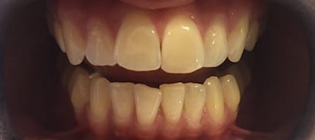 Before and After Invisalign Treatment Milton Keynes Before and After Invisalign Treatment Milton Keynes