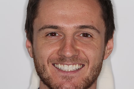 Before and After Invisalign Treatment Milton Keynes Before and After Invisalign Treatment Milton Keynes