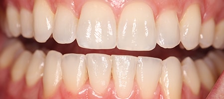 Before and After Invisalign Treatment Milton Keynes Before and After Invisalign Treatment Milton Keynes